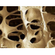 Detección Precoz de Osteoporosis