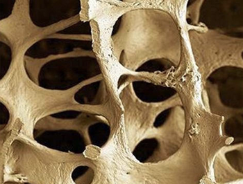 Detección Precoz de Osteoporosis